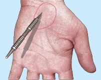 An image of the stomach pain point being found.