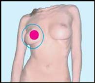 Alternative medicine. Breast cancer - treatment with su jok therapy ( acupuncture ).