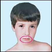 Alternative medicine. Suppurative tonsillitis - treatment with su jok therapy ( acupuncture ).