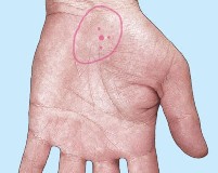 A marked pain point of the stomach.